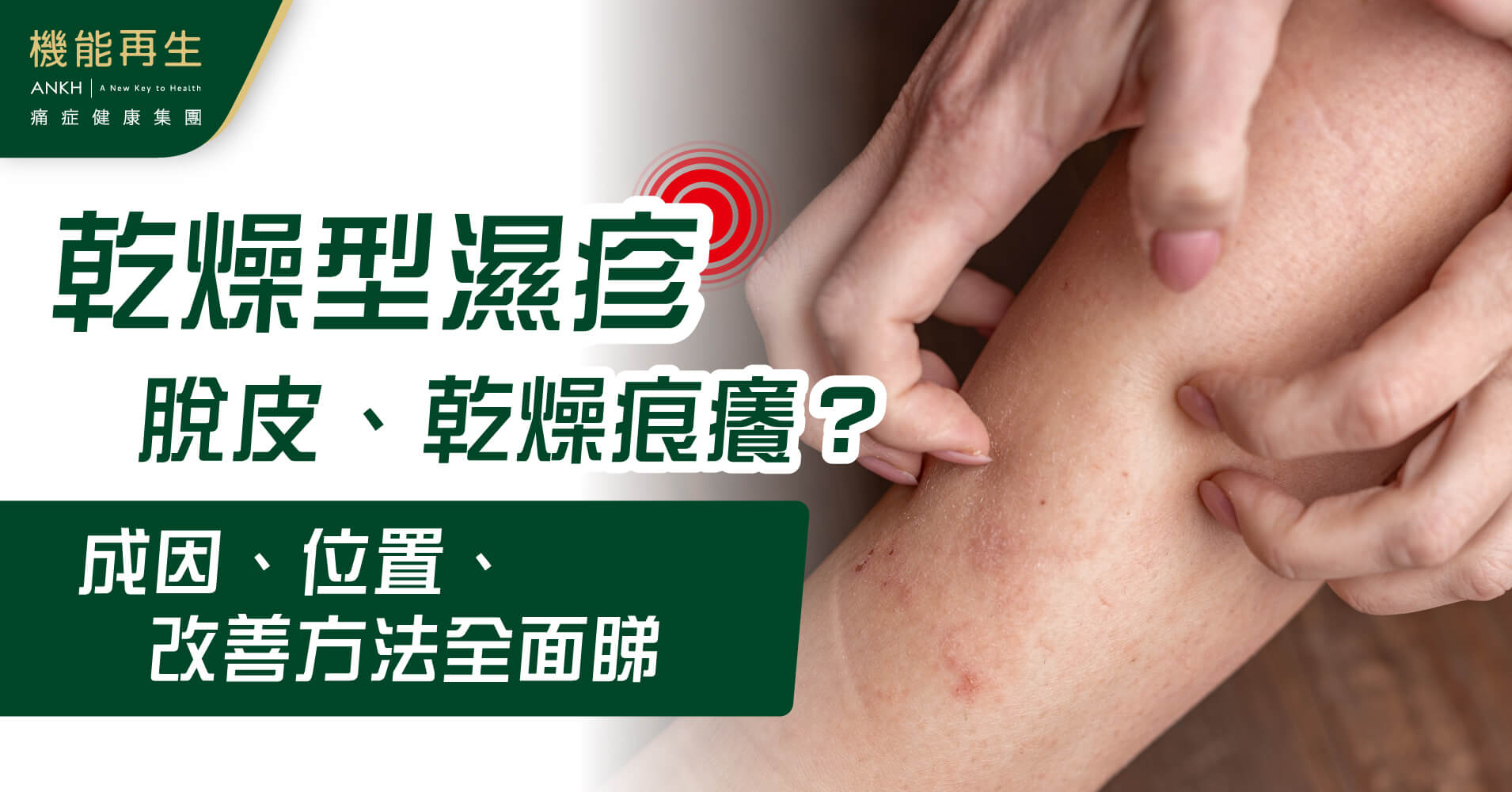 乾燥型濕疹脫皮、乾燥痕癢？成因、位置、改善方法全面睇